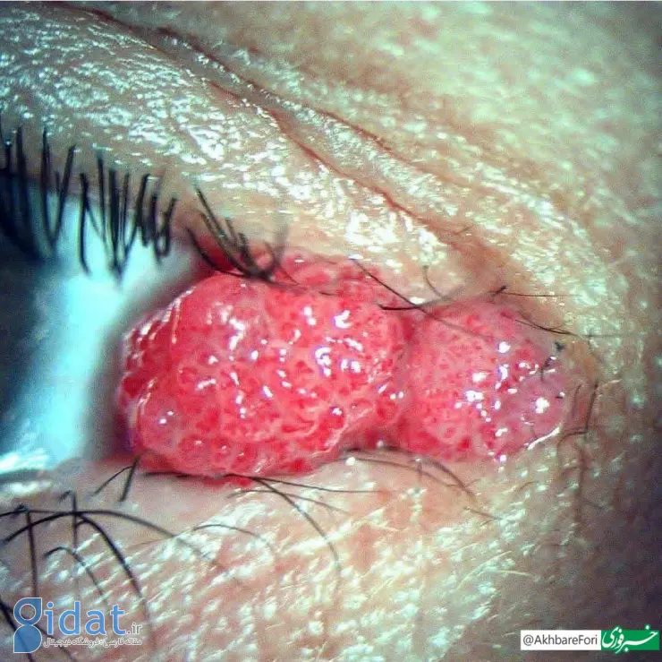 تصویر ترسناک از چشم آلوده به ویروس HPV!