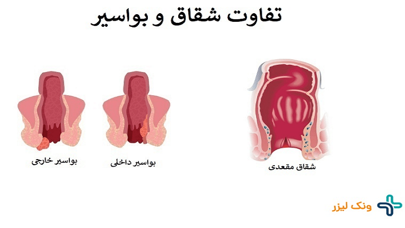 تفاوت شقاق و بواسیر چیست ؟