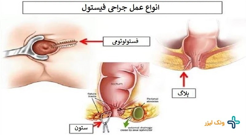 انواع عمل فیستول و عوارض آن