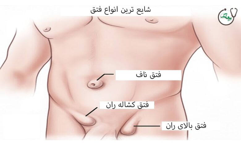 فتق در کودکان و بارداری ( عوارض عدم درمان فتق)