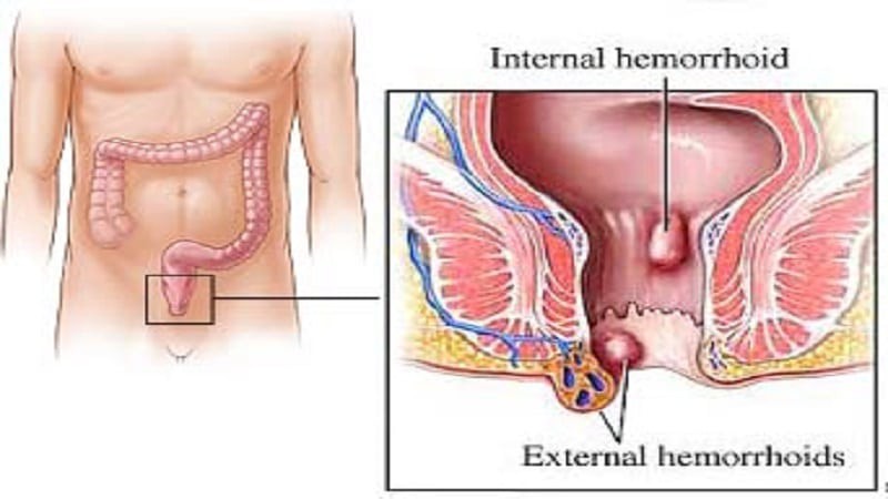 انواع روش های درمان هموروئید داخلی (خانگی، دارویی، جراحی و بدون جراحی)