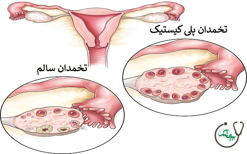 درمان خانگی تنبلی تخمدان+رژیم غذایی