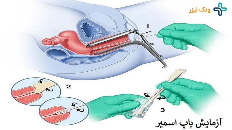 پیشگیری و درمان زگیل تناسلی زنان