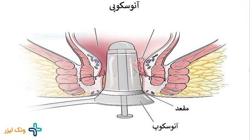 معاینه مقعدی با آنوسکوپی