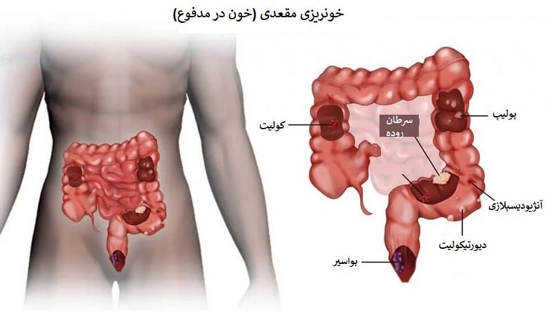 انواع خونریزی مقعدی و درمان خانگی