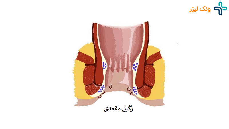 درمان و پیشگیری زگیل مقعدی در زنان و مردان