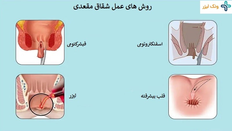 انواع جراحی شقاق و عوارض آن