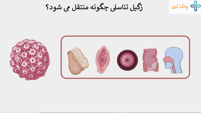 شرح چگونگی انتقال زگیل تناسلی