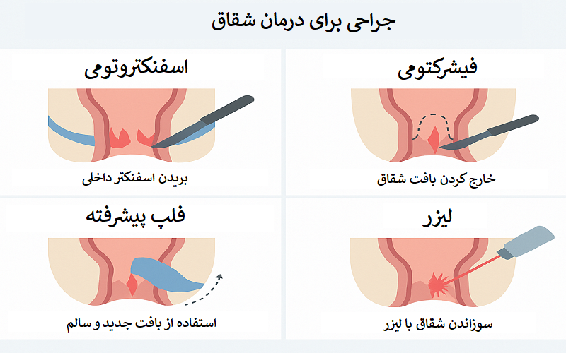اگر شقاق با روشهای خانگی و دارو درمان نشد چه کنیم؟