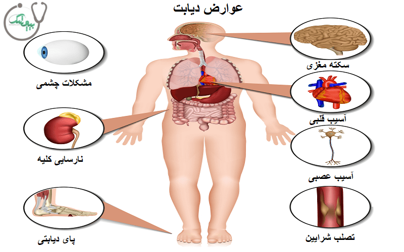 بررسی عوارض جانبی بیماری دیابت برای مردان و زنان