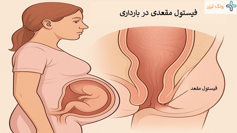 فیستول مقعدی در بارداری