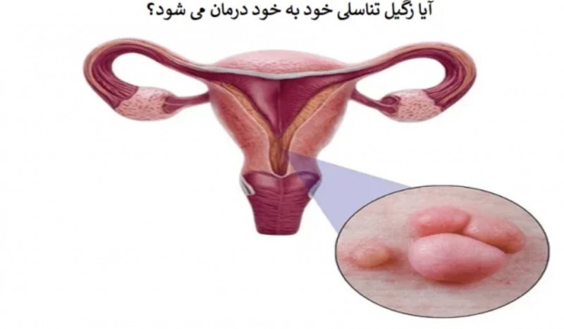 آیا زگیل تناسلی خود به خود خوب می شود؟