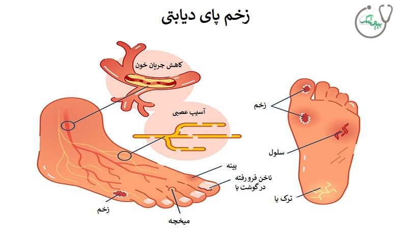 زخم پای دیابتی چیست و چه علائمی دارد؟