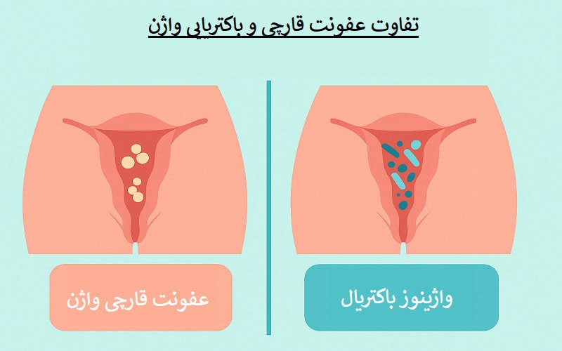 روش های درمان درمان واژینوز باکتریال و عفونت قارچی واژن