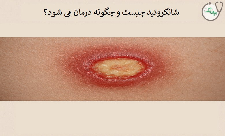علت ابتلا به بیماری شانکروئید چیست؟