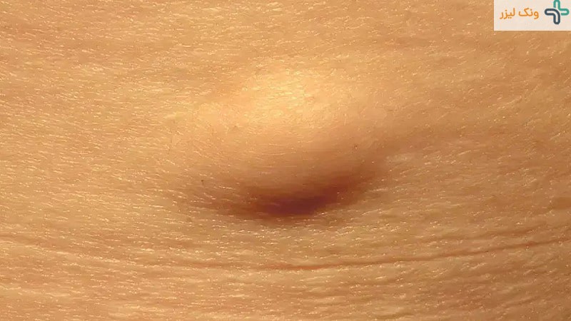 علت تشکیل لیپوم مقعد (توده چربی در مقعد) چیست؟