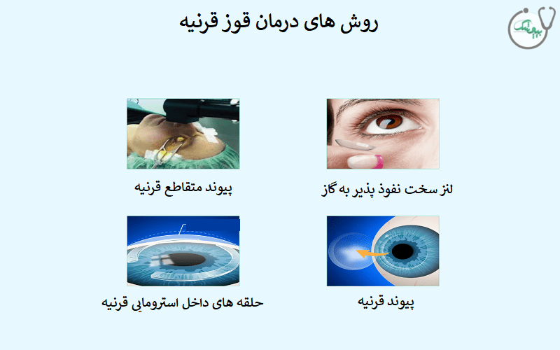 روش های تشخیص و درمان قوز قرنیه