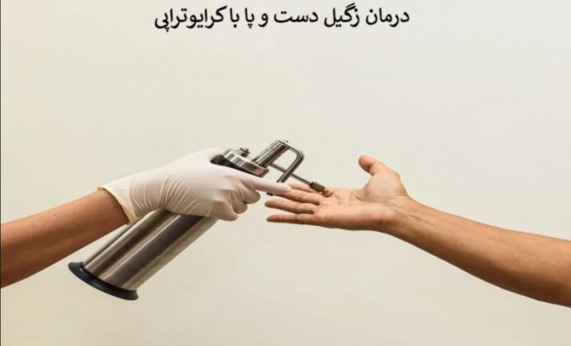 کرایو زگیل دست و پا چیست و چگونه انجام می شود؟