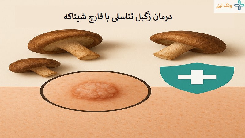 نحوه مصرف قارچ شیتاکه برای زگیل تناسلی چیست؟
