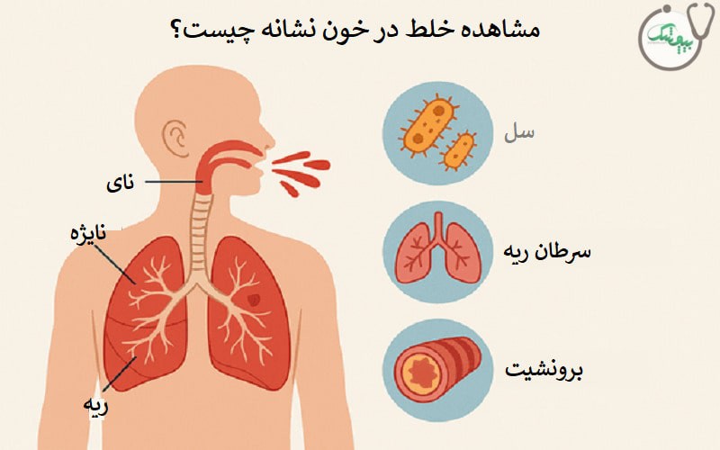 خلط خونی چگونه درمان می شود؟