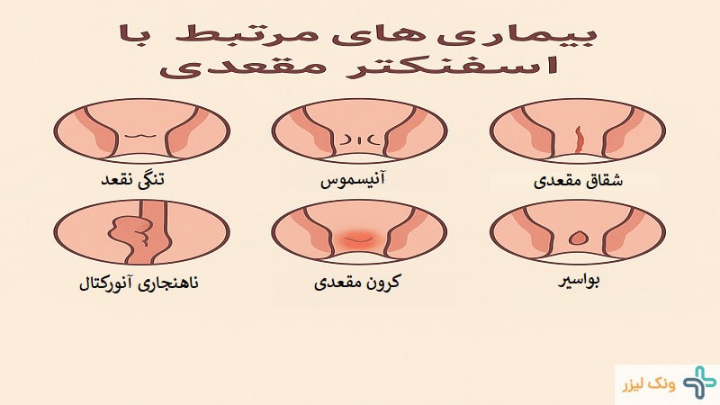 کدام بیماری ها به اسفنکتر مقعد آسیب می رسانند؟