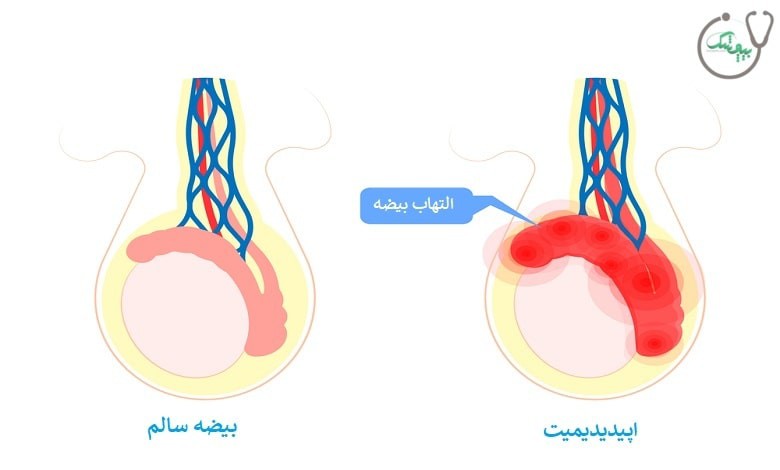 آیا برای درمان اپیدیدیمیت به جراحی نیاز است؟