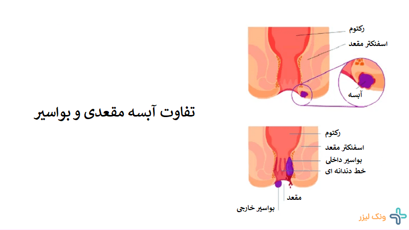 بواسیر با آبسه مقعدی چه فرقی داره؟
