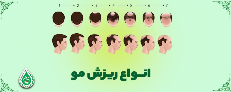 انواع ریزش مو