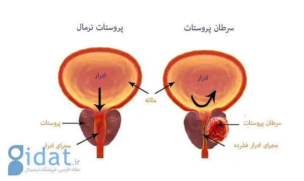 سرطان و ناباروری در مردان