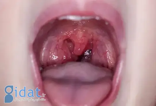 التهاب لوزه