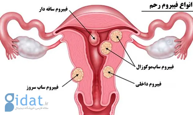 بارداری با وجود فیبروم رحم| نی نی سایت