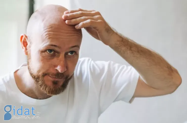 امیدی تازه برای درمان طاسی؛ داروی جدید در آزمایش‌ها باعث رشد ۵۳۹ درصدی مو شده است