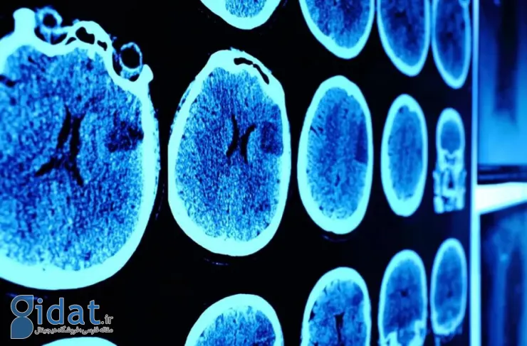 تومور مغزی یک بیمار 13 ساله برای اولین بار در جهان به طور کامل درمان شد