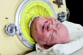 مردی پس از 70 سال زندگی بر اثر "ریه آهنی" درگذشت