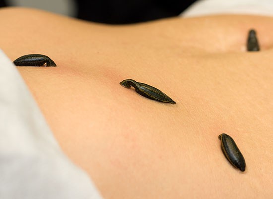 زالودرمانی در خانه