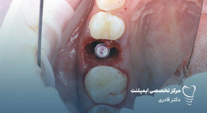 قیمت ایمپلنت دندان با احتساب هزینه جراحی و روکش