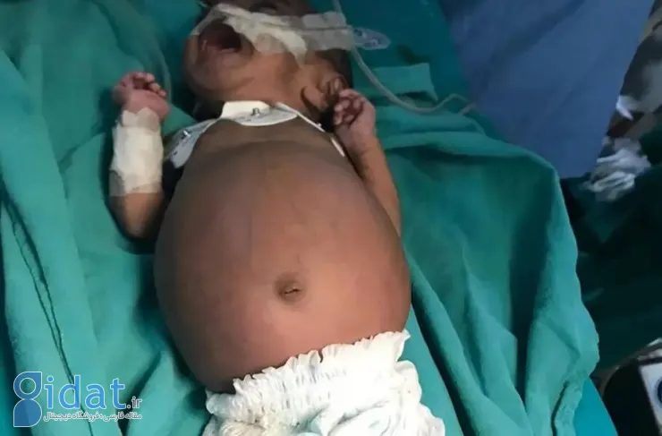 تولد نوزادی که در شکمش جنین دوقلوی خود را داشت!