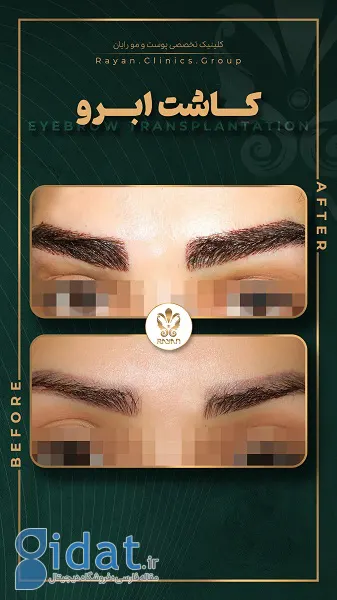 هر آنچه که باید در مورد کاشت ابرو بدانید