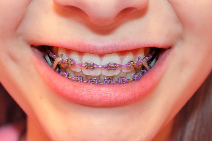 ارتودنسی دندان یه چه صورت انجام می شود؟