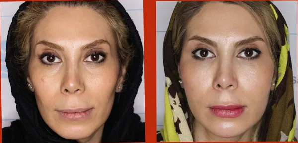 لیفت صورت بدون جراحی با 16 روش مختلف