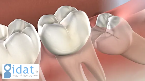 جراحی دندان عقل هزینه و مراقبت بعد از جراحی