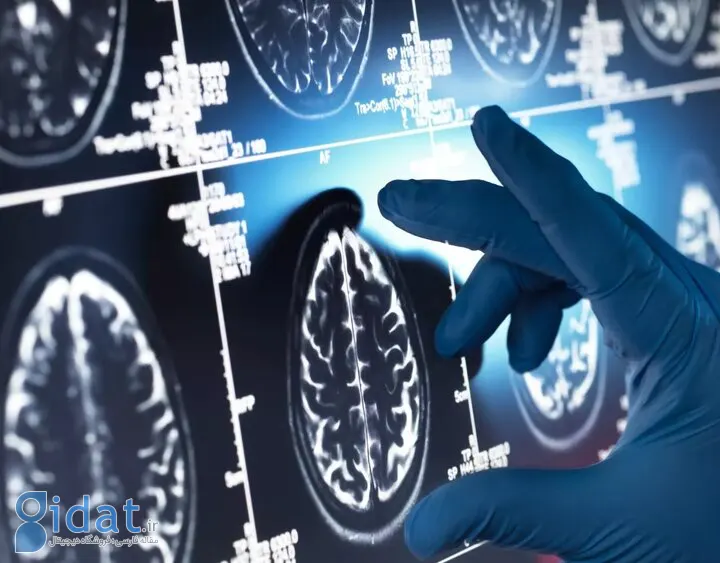 یک داروی گیاهی مفید علیه آلزایمر