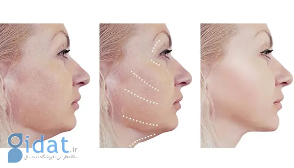 لیفت صورت بدون جراحی با ۱۶ روش مختلف