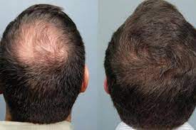 کاشت مو بهترین روش برای بازیابی موهای از دست رفته است ؟