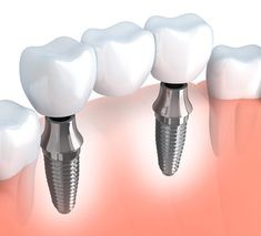 کسب اطلاعات درباره ایمپلنت فوری