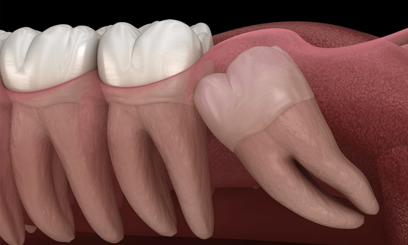 چرا باید دندان عقل را جراحی کنیم و بکشیم؟
