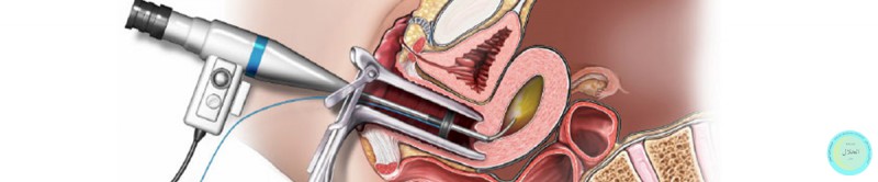 هیستروسکوپی تشخیصی درمانی