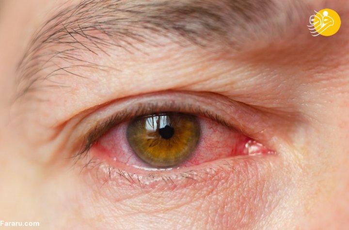 علت و درمان های ساده برای قرمزی چشم
