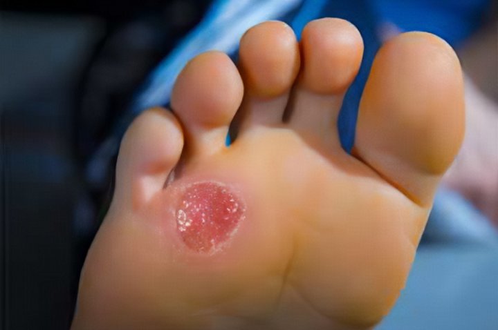 زخم پای دیابیتی؛ علل، نشانه ها و راه های درمان آن