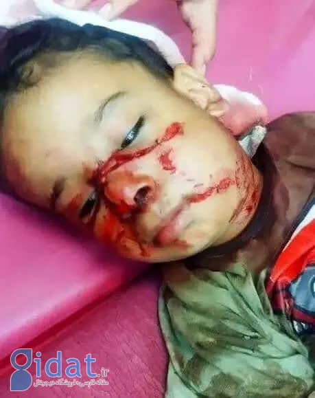 تصویر دلخراش از حمله سگ به کودک خوزستانی